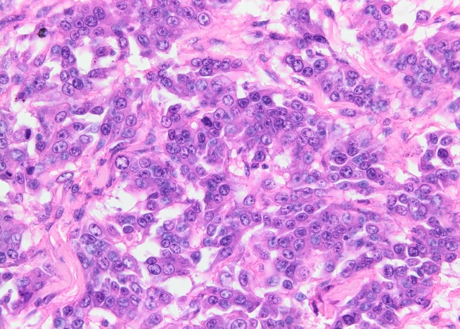Cells in this field are epithelioid and have nucleo-cytoplasmic atypia 