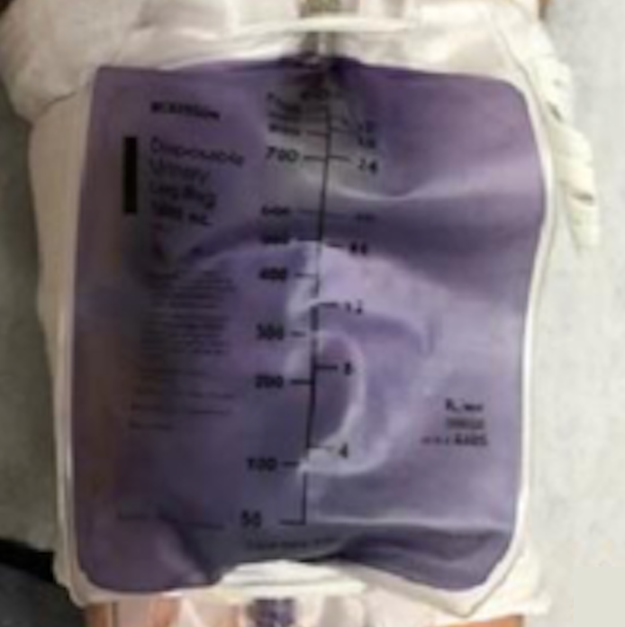 Purple urinary bag syndrome