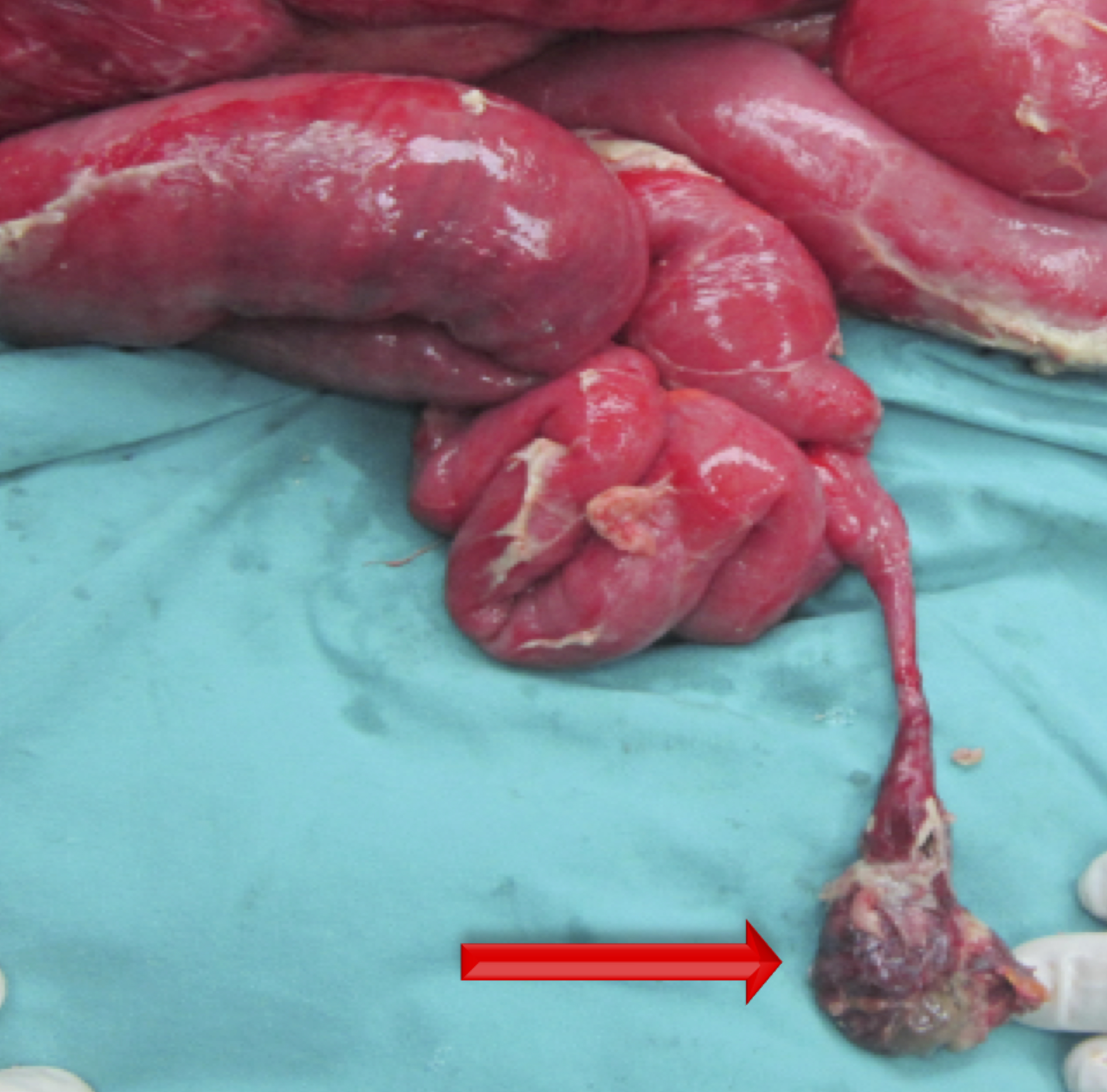 Intraoperative photograph of the inflamed Meckel's Diverticulum  affecting a distant small bowel loop