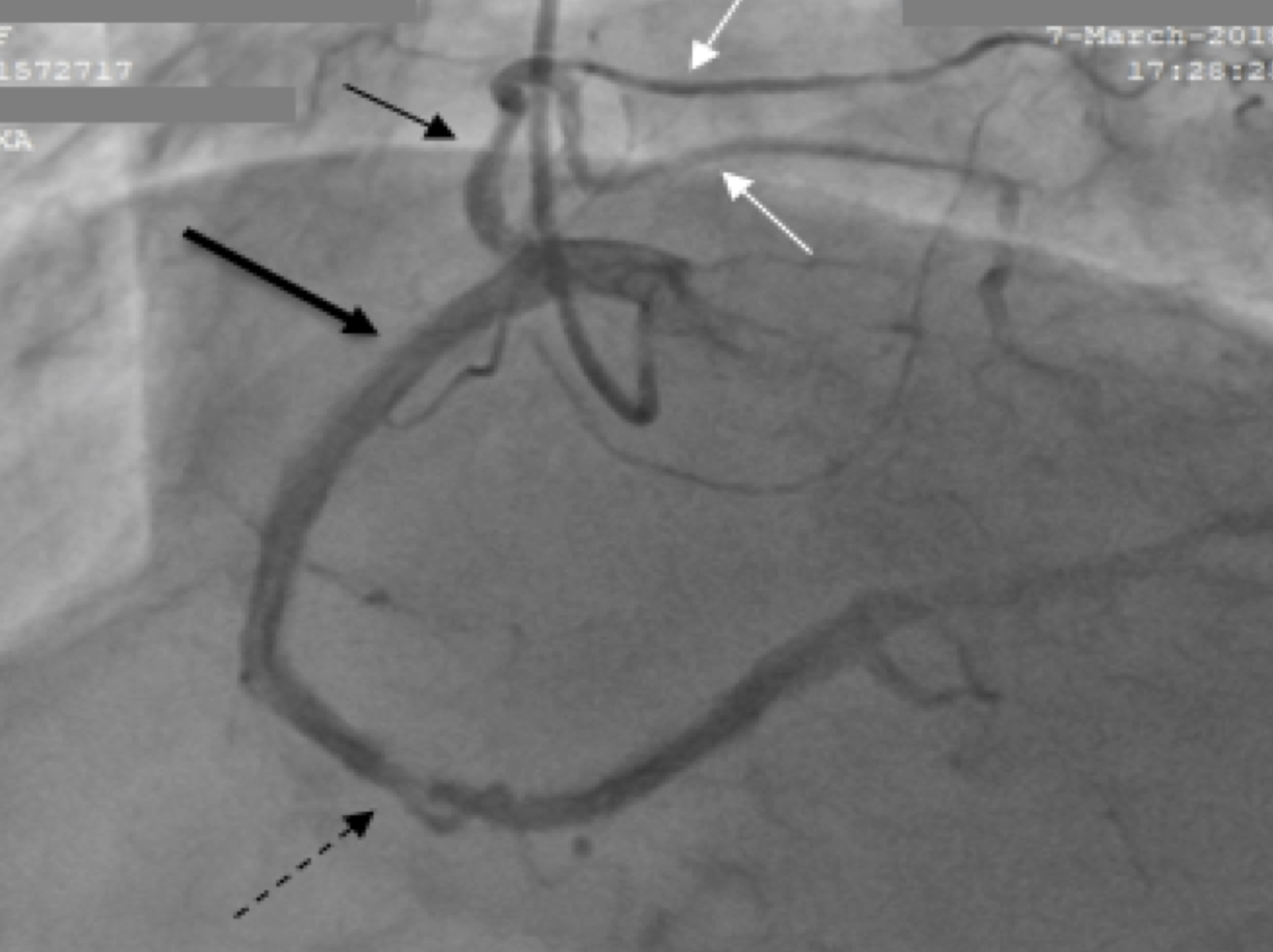 Coventional coronary angiogram SCA