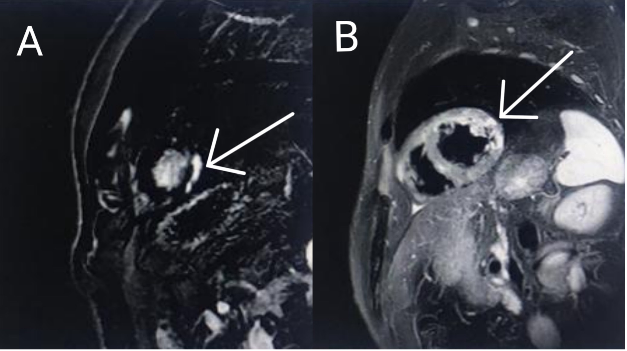 Cardiac magnetic resonance imaging. A: subepicardial lateral apical delayed gadolinium