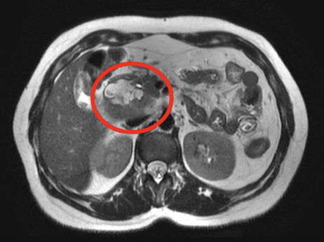 Transverse section of MRI done at 5 weeks gestation showing the 4.9 x 4.6 cm (TV x AP) well defined ampullary mass appearing as mixed with cystic and solid components