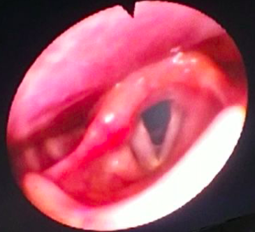 Laryngoscopy showing right vocal cord paresis with incomplete abduction