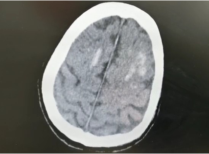 Intracranial bleeding in the corticomedullary junction