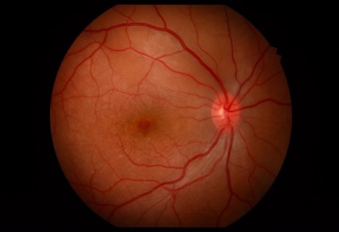 Fundus of the patient showing folds of sensory retinal detachment centered around the macula