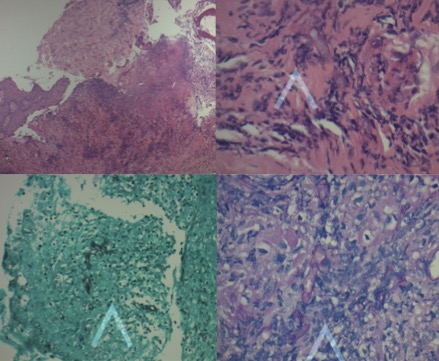 (A) H and E-stained section (4x) from palate region showing squamous epithelium with necrosis and focal ulceration and a (B) (40x) magnification revealing non septated broad fungal hyphae (arrow) within a background of epithelial cells and inflammatory cells, (C) Grocott stained section (40x) showing non septated fungal hyphae branching at 90-degree angle in black (arrow), (D) periodic acid–Schiff-stained section (40x) highlighting broad non septated fungal hyphae in pink.