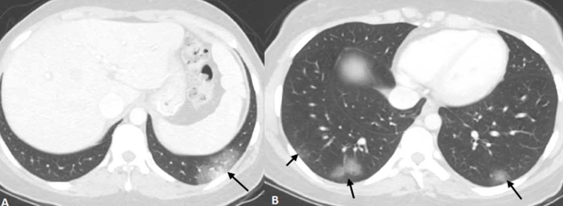 Axial CT scan images of the lower cuts of the chest (lung window) showing bilateral peripheral ground glass opacities associated with subtle interstitial intralobular septal thickening and lobular consolidation, typical for COVID-19 infection.