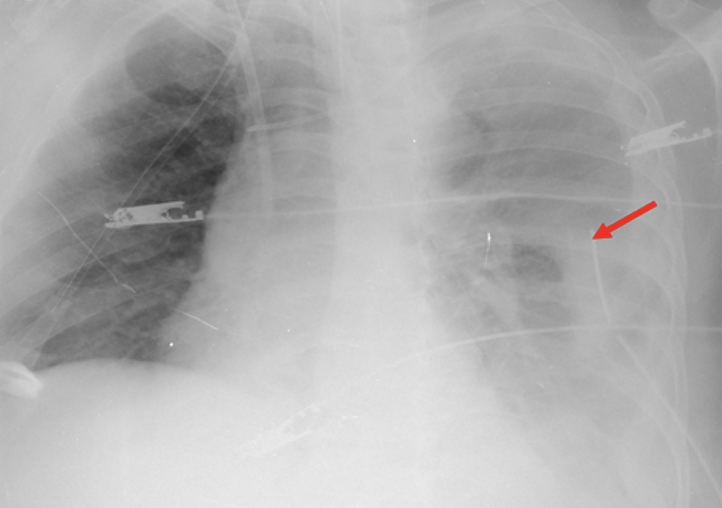 Chest x ray of the patient after left anterior chest tube (red arrow) was placed for drainage of the left hemothorax.