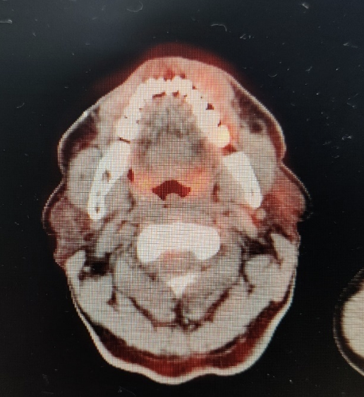Axial section of PET scan demonstrating FDG uptake at the buccal mucosal lesion.
