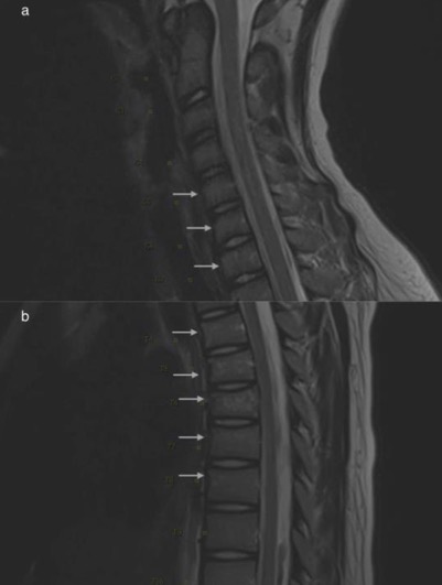 Sagittal T1-weighted magnetic resonance imaging of cervical and thoracic spine revealing multiple compression fractures involving C5-T1 vertebral bodies (a) and T4-T8 (b).