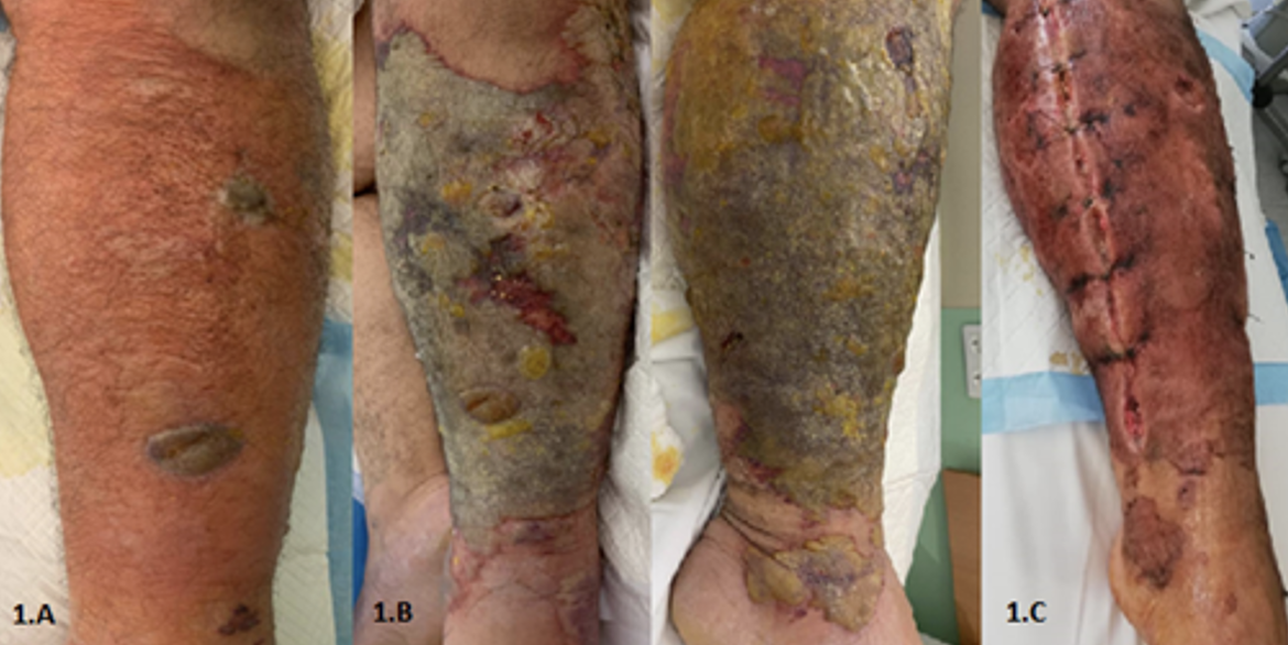 Upon presentation; left leg showing mild erythema and edema with black ruptured bulla. B: Day 5 post admission; the erythema and edema worsened significantly, the skin appears necrotic, green-grey discoloration and oozing of pus and several ulcerations. C: Day 2 post fasciotomy with open wounds.