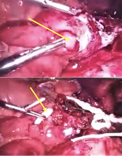 Intraabdominal laparoscopy showing small bowel perforation with an underlying taenia saginata.