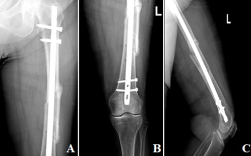 Radiographs of the left femur in the (A, B) Antero-posterior and (C) lateral views done 3 months post operatively showing the intramedullary nail in place stabilizing a healing fracture. A callus is noted with adequate alignment