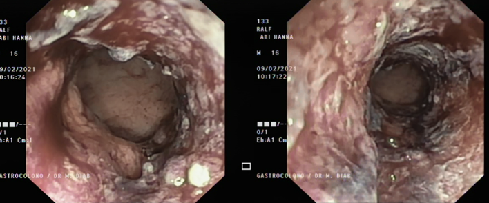 Colonoscopy of a Lebanese 15-years-old child demonstrating ulceration and severe inflammation of the mucosa in the rectosigmoid junction.
