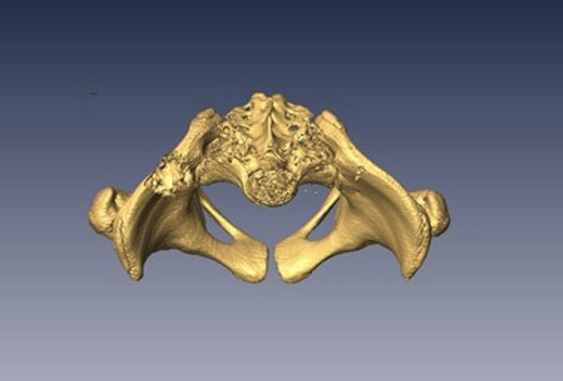3D reconstructed pelvis viewed superiorly