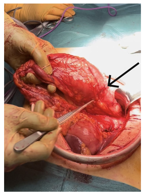 Image taken during Laparotomy showing the intussusception at the colon hepatic angle after its mobilization. (arrow: Colocolic intussusception).