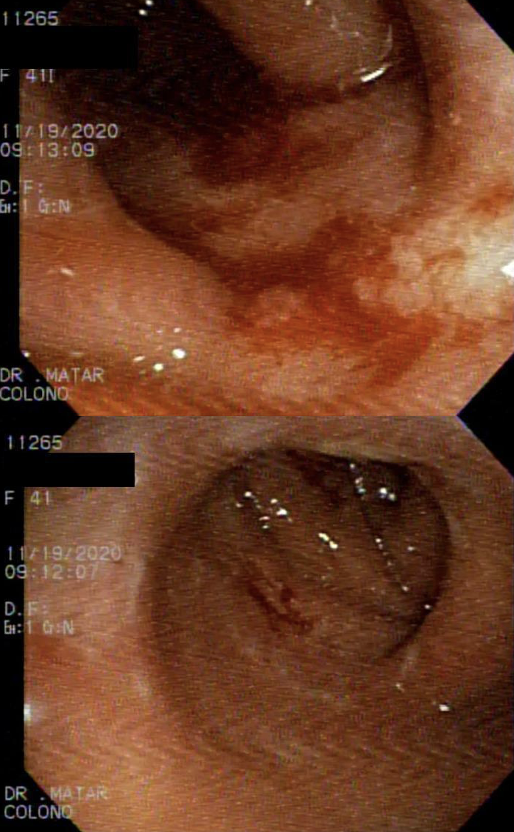 Figure showing diffuse edematous, hyperemic mucosa with erosions and superficial ulcers on colonoscopy 