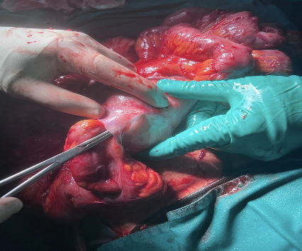 Intraoperative photograph during adhesiolysis of encapsulated bowel loops