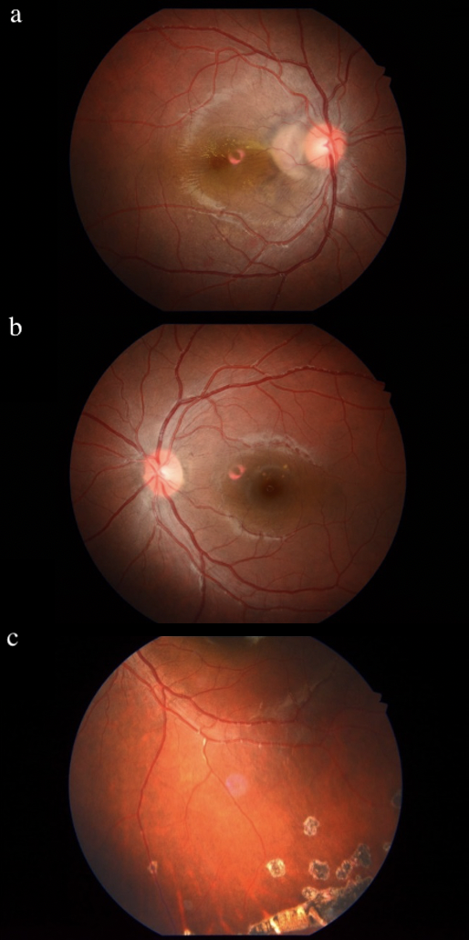 : Fundus photography, 1a: Fundus photography. OD showing juxtapapillary infiltrates with serous macular detachment, and small retinal and choroidal lesions. 1b: Fundus photography. OS showing peripapillary atrophy. 1c: Fundus photography of the peripheral left eye showing multiple atrophic chorioretinal scars (histospots) with some small retinal lesions.