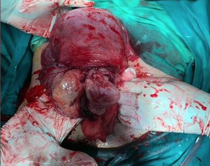 Spontaneous extrusion of the uterine mass after placental delivery