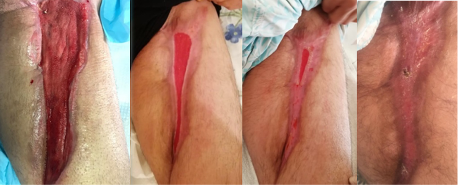 Progression of secondary wound healing