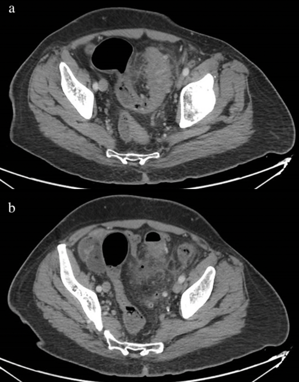 Computed Tomography Scan of the abdomen showing a circumferential short segment wall thickening of the sigmoid colon with multiple diverticular pouches and significant surrounding fat stranding