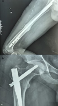 Radiographic imaging of the right femur showing a well-positioned gamma nail, with no signs of infection, malunion, or pseudoarthrosis; 1a: Anteroposterior view & 1b: Lateral view
