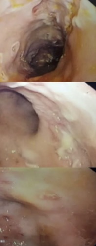 Colonic ulcerations seen on the first colonoscopy