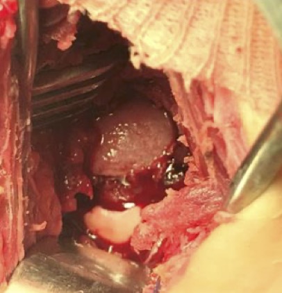 Gross picture taken intraoperatively, showing the antero-superior and external part of the femoral epiphysis is completely stripped of its cartilage.