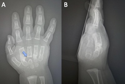 (A) Anteroposterior and (B) Lateral radiographic images of the right hand, 7 months since the first presentation, showing the consolidation of the 2nd, 4th, and 5th metacarpals. The 3rd meta-carpal shows evidence of pseudoarthrosis (arrow)