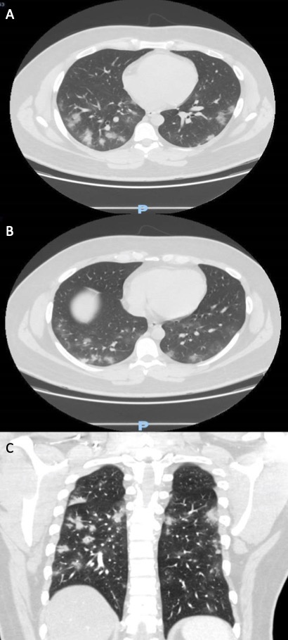 Chest computed tomography showing bilateral ground-glass opacities, more pronounced in the dependent areas of the lungs