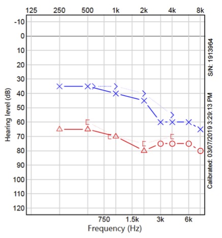 Audiometry to evaluate hearing loss. Findings: Left ear: Mild, sloping to moderately-severe, sensorineural hearing loss, with excellent Word Recognition Score (WRS). Right ear: Moderately-severe, sloping-to-severe sensorineural hearing loss, with good WRS.