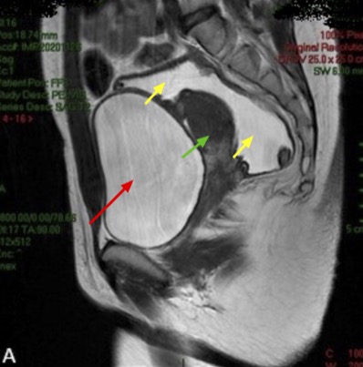MRI of the pelvis showing the fluid-filled cyst in the Douglas space, extending to the parauterine space on T2-weighted images in the sagittal cut