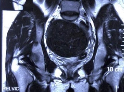 Pelvic MRI showing enlarged rudimentary horn